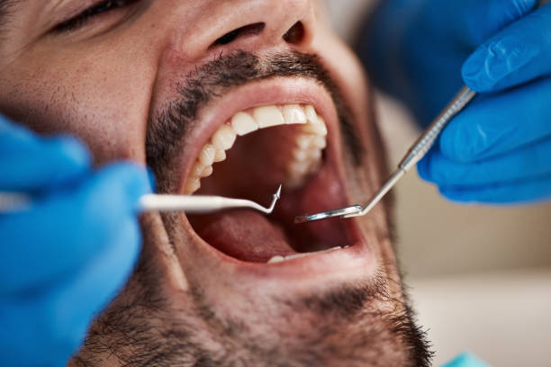 Best Emergency Dental Care for Broken or Chipped Teeth in Hillcrest, CA